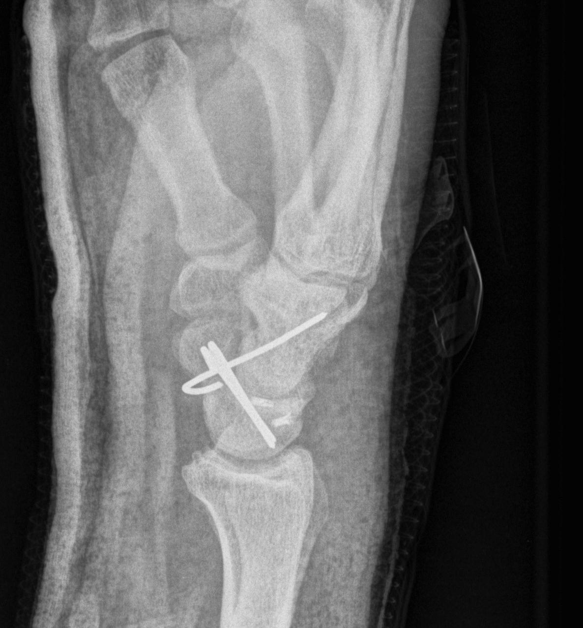 Perilunate Dislocation Lateral ORIF